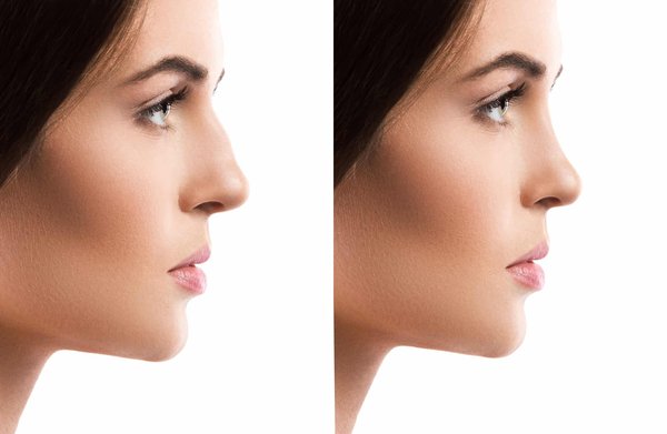Quels sont les différents cas particuliers de la rhinoplastie ultrasonique ?
